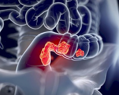 cancer de colon y recto