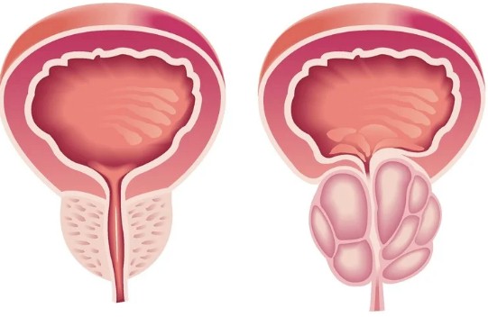hipertrofia prostata