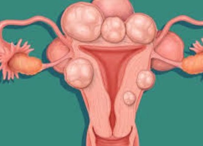 miomas utero