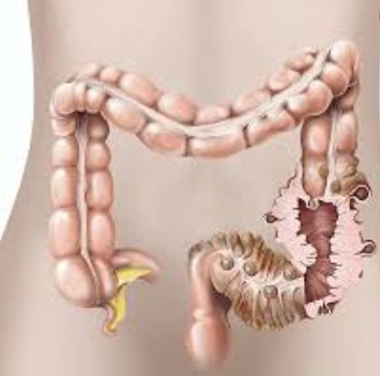 enfermedad diverticular