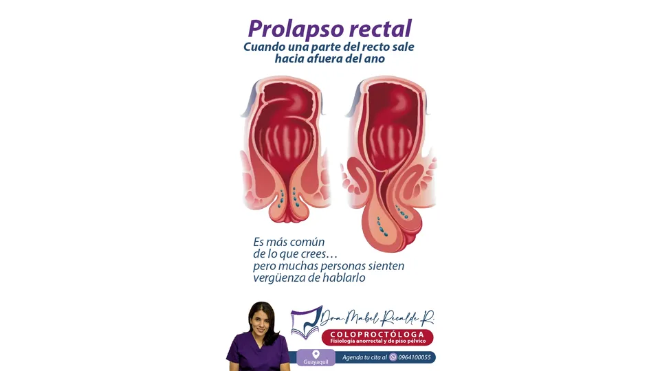 Imagen sobre Prolapso rectal: síntomas y valoración coloproctológica