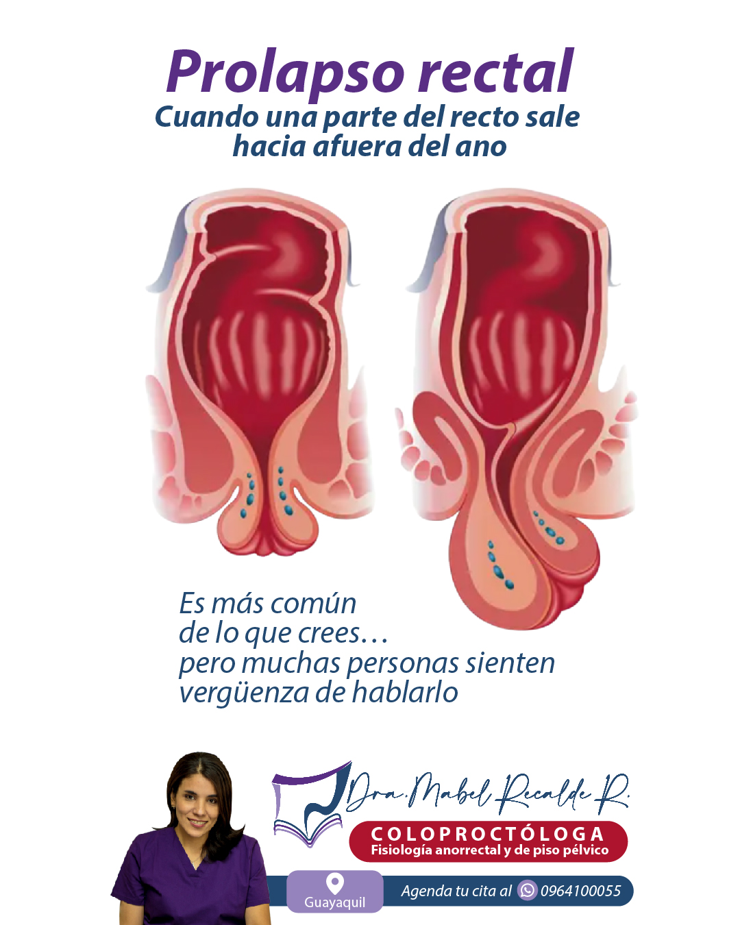 Prolapso rectal: síntomas y valoración coloproctológica
