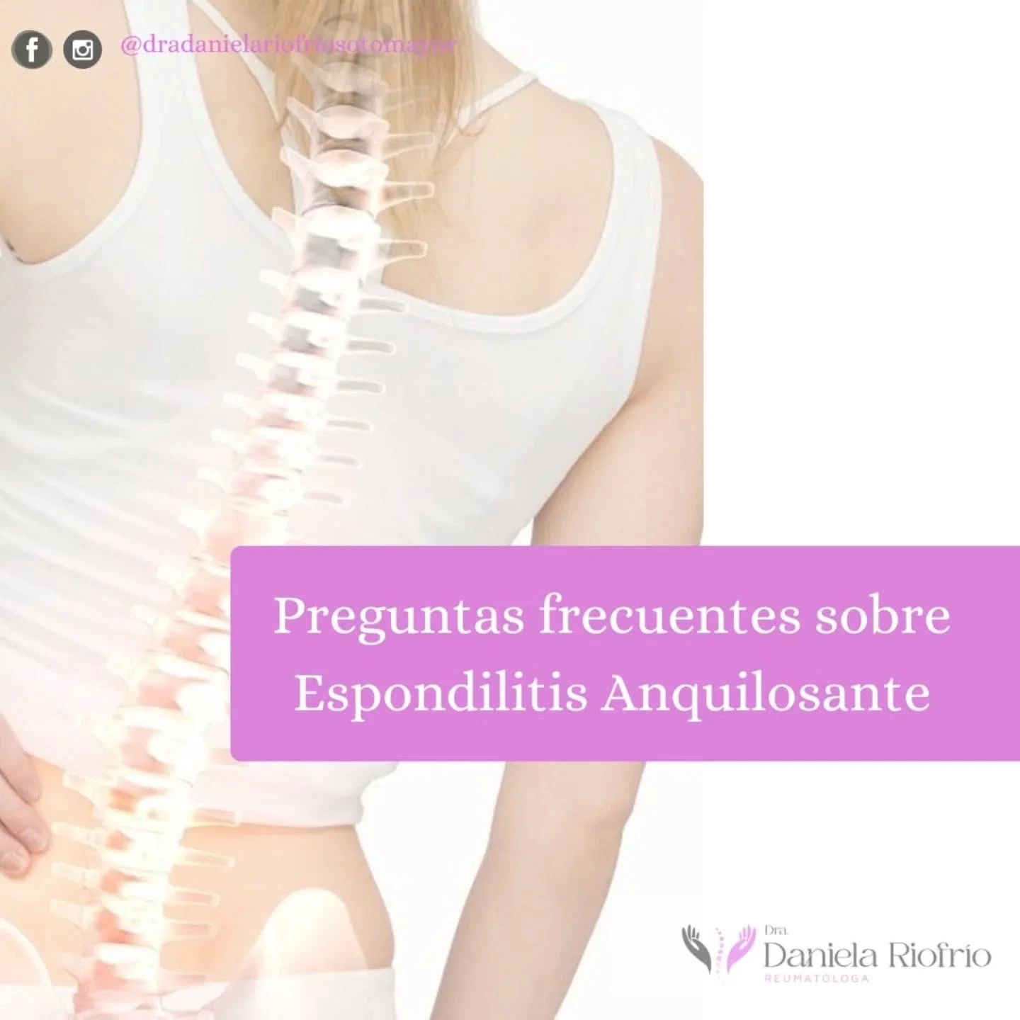 Espondilitis anquilosante: preguntas frecuentes y síntomas