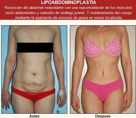 ABDOMINOPLASTIA GUAYAQUIL