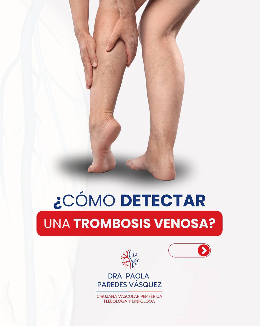 Trombosis venosa: señales de alerta en una pierna