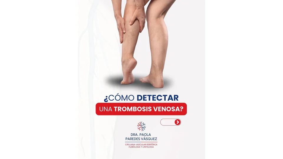 Imagen sobre Trombosis venosa: señales de alerta en una pierna