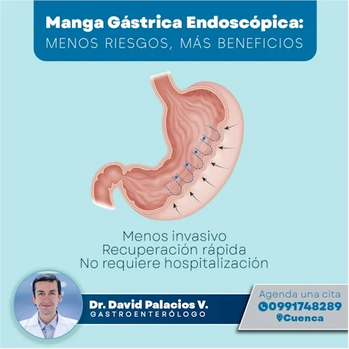 MANGA GASTRICA EN CUENCA ECUADOR