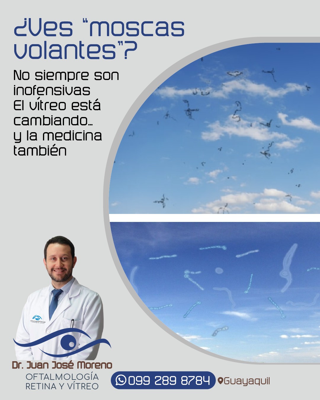 Moscas volantes: cuándo deben ser evaluadas por un oftalmólogo