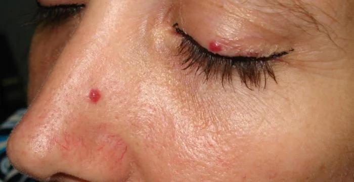 Imagen del artículo Angiomas