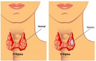 Imagen del artículo Qué es un n?ulo tiroideo y c?o se debe tratar?