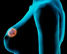 Imagen del artículo Quédebe hacer para prevenir el cáncer de mama?