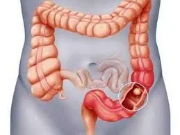 Gastroenterólogos en Cuenca