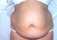 Imagen del artículo Cirugía Plástica del Abdomen en Guayaquil- Abdominoplastia