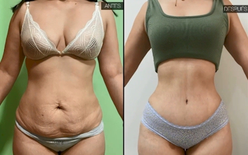 ABDOMINOPLASTIA