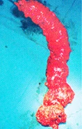 Imagen relacionada con canceranorectales2