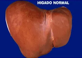 hígado Graso - Todo lo que querias saber