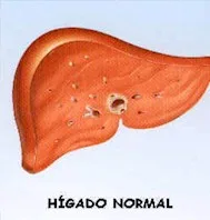 hígado Graso - Todo lo que querias saber