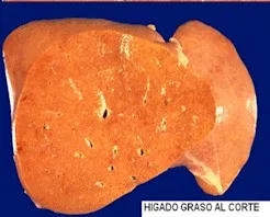 hígado Graso - Todo lo que querias saber