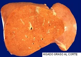 hígado Graso - Todo lo que querias saber