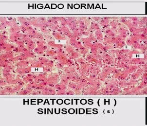 hígado Graso - Todo lo que querias saber