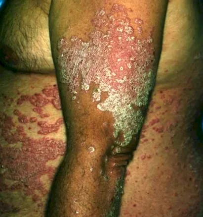 Psoriasis