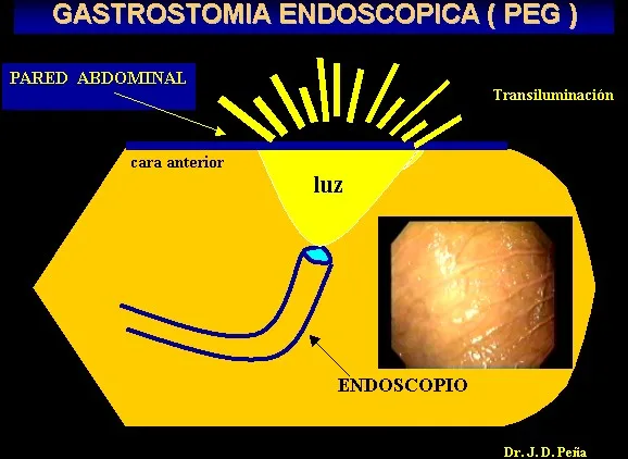 GASTROSTOMIA ENDOSCOPICA PERCUTANEA