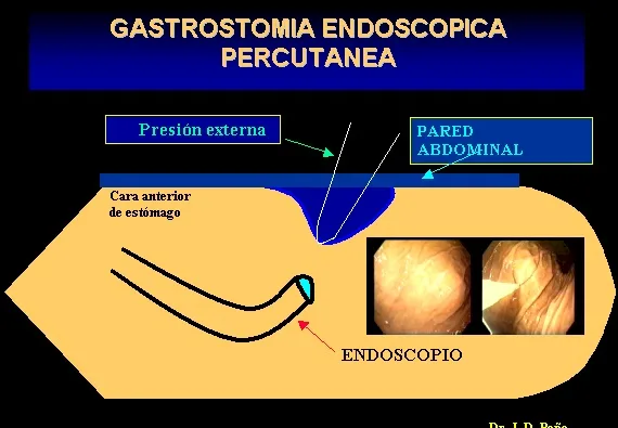 GASTROSTOMIA ENDOSCOPICA PERCUTANEA
