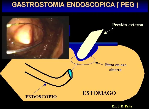 GASTROSTOMIA ENDOSCOPICA PERCUTANEA