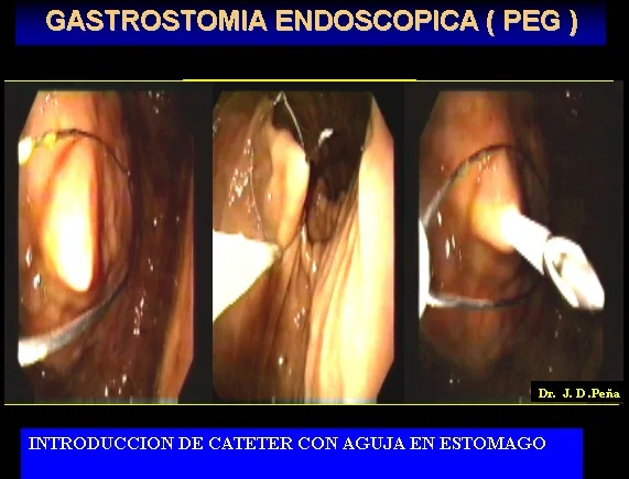 GASTROSTOMIA ENDOSCOPICA PERCUTANEA
