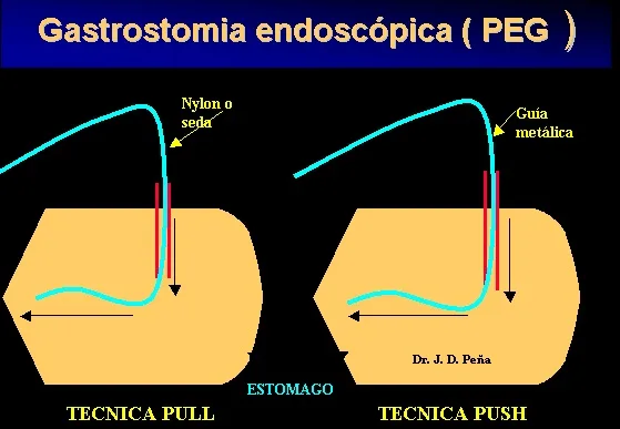 GASTROSTOMIA ENDOSCOPICA PERCUTANEA