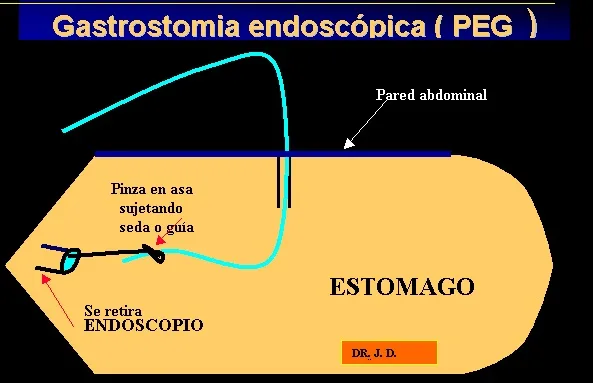 GASTROSTOMIA ENDOSCOPICA PERCUTANEA