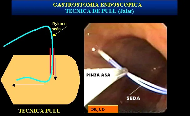 GASTROSTOMIA ENDOSCOPICA PERCUTANEA