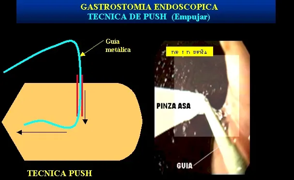 GASTROSTOMIA ENDOSCOPICA PERCUTANEA