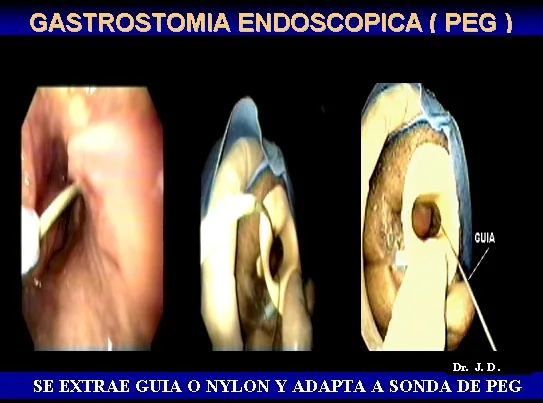 GASTROSTOMIA ENDOSCOPICA PERCUTANEA