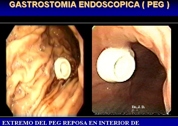 GASTROSTOMIA ENDOSCOPICA PERCUTANEA