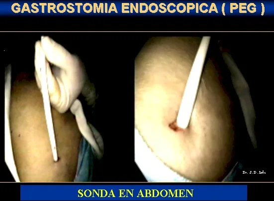 GASTROSTOMIA ENDOSCOPICA PERCUTANEA
