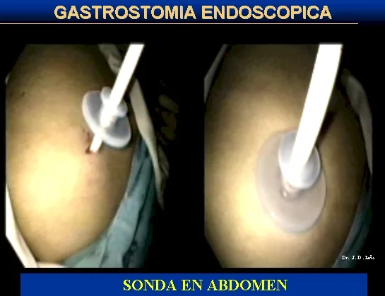 GASTROSTOMIA ENDOSCOPICA PERCUTANEA