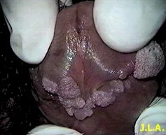 Fallas en el tratamiento de infección por VPH (Papiloma Virus Humano)