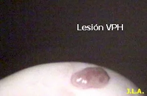 Fallas en el tratamiento de infección por VPH (Papiloma Virus Humano)