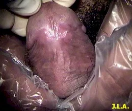 Fallas en el tratamiento de infección por VPH (Papiloma Virus Humano)
