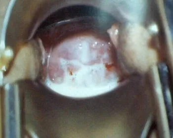Infección genital por Clamydia Trachomatis