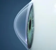 QUERATOCONO