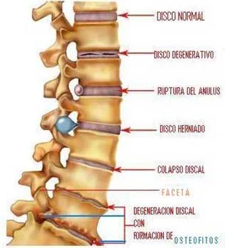 Lumbociatica CON RADIOFRECUENCIA - Guayaquil Ecuador - Dr. Angel Auad
