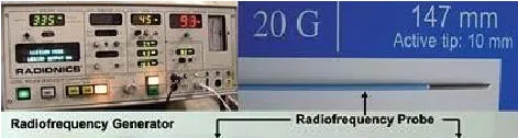 Lumbociatica CON RADIOFRECUENCIA - Guayaquil Ecuador - Dr. Angel Auad
