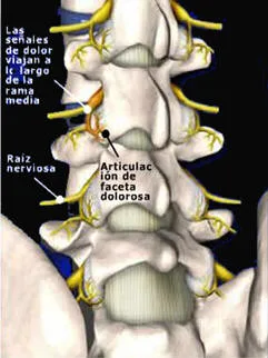 Lumbociatica CON RADIOFRECUENCIA - Guayaquil Ecuador - Dr. Angel Auad