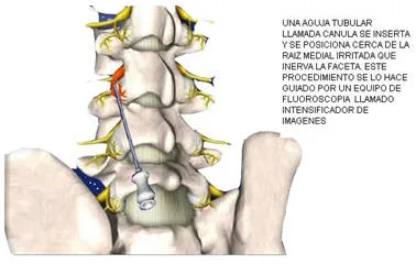 Lumbociatica CON RADIOFRECUENCIA - Guayaquil Ecuador - Dr. Angel Auad