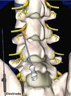 Lumbociatica CON RADIOFRECUENCIA - Guayaquil Ecuador - Dr. Angel Auad