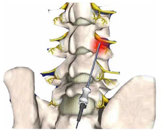 Lumbociatica CON RADIOFRECUENCIA - Guayaquil Ecuador - Dr. Angel Auad