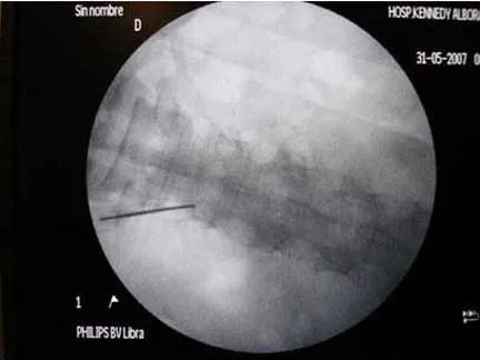 Lumbociatica CON RADIOFRECUENCIA - Guayaquil Ecuador - Dr. Angel Auad