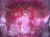 Cómo evitar el cáncer de cuello uterino